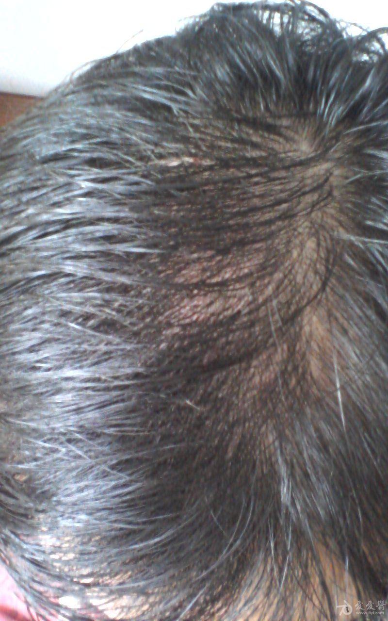 منع تساقط الشعر - استراتيجيات فعالة في علاج تساقط الشعر