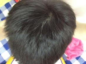 اسباب تساقط الشعر عند الاطفال