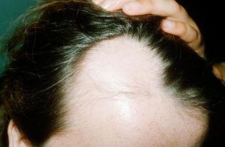 حلول فعالة في علاج تساقط الشعر