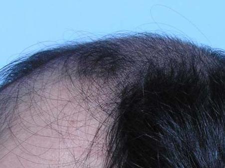 العلاج النهائي لتساقط الشعر