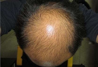علاج ومنع تساقط الشعر بماء الحديد