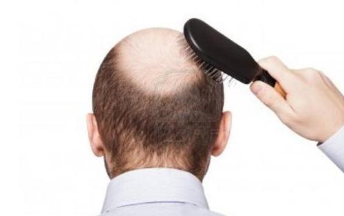 طريقة لعلاج تساقط الشعر