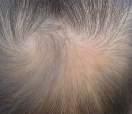 علاجات تساقط الشعر للرجال