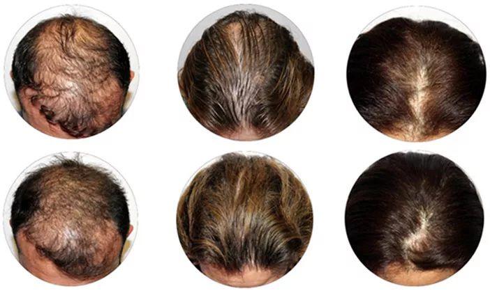 علاج تساقط الشعر بالوصفات بالاعشاب