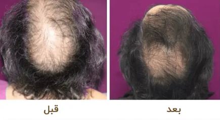 لعلاج تساقط الشعر