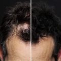 علاجات تساقط الشعر