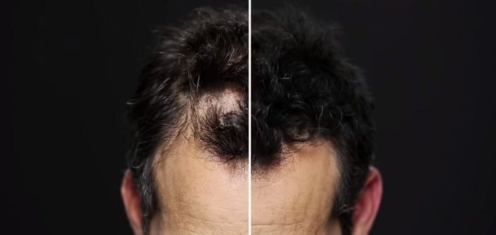 علاجات تساقط الشعر