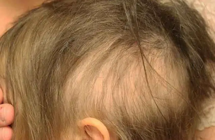 تساقط الشعر عند الرضع