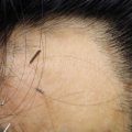 العلاجات غير الدوائية لتساقط الشعر
