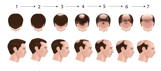 علاجات تساقط الشعر عند الرجال والنساء